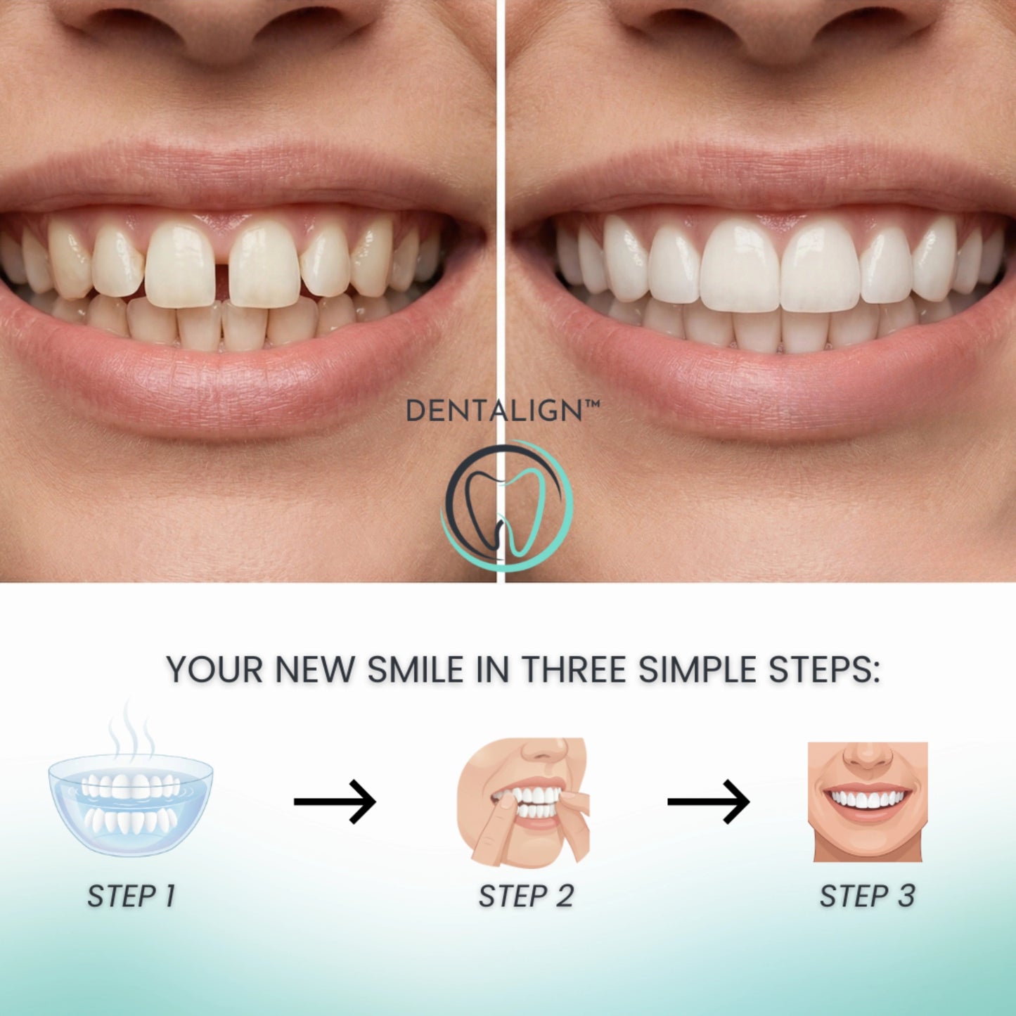 Clip-On Veneers – Dentalign™